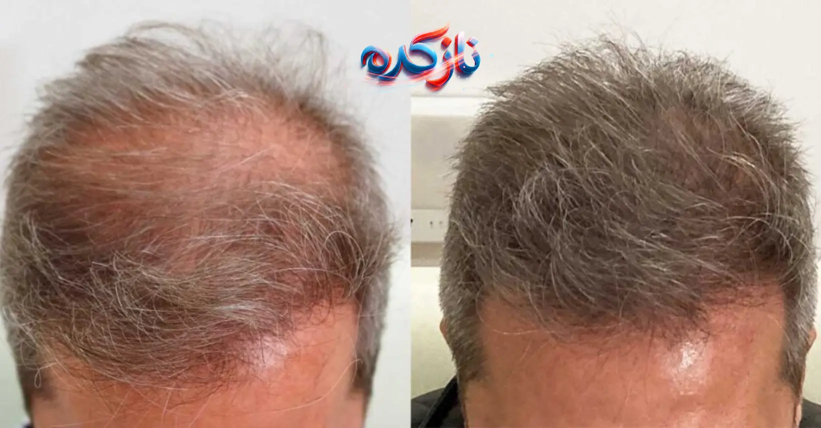 نتایج واقعی بعد از مصرف قرص هیرتامین