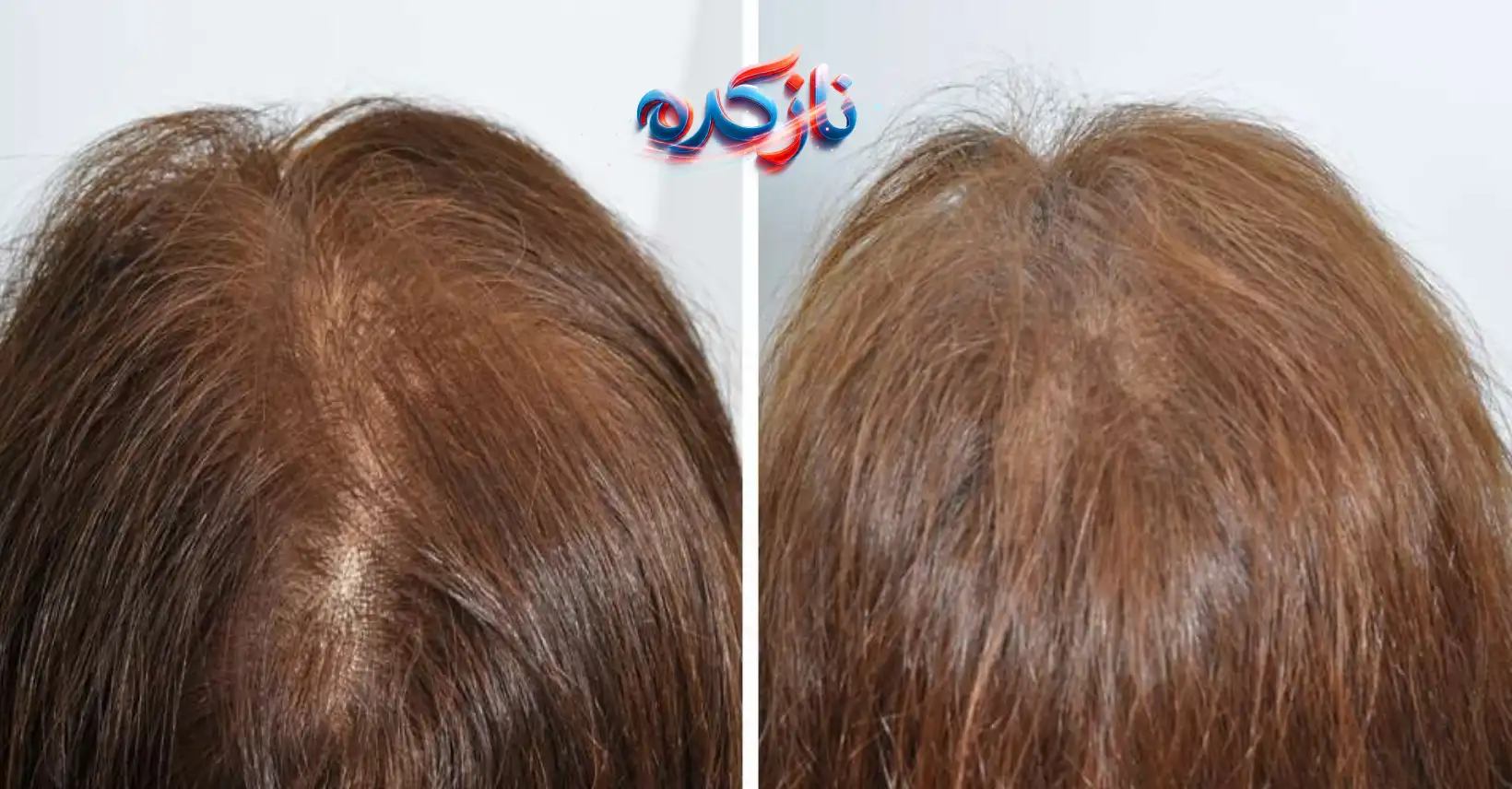 نتایج کاربران از استفاده قرص هیرتامین اصل